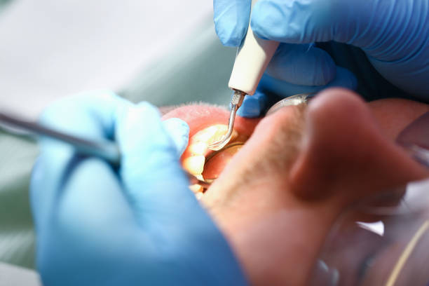 Best Emergency Tooth Extraction in Dillsboro, IN